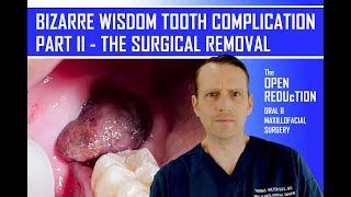 PART 2: BIZARRE COMPLICATION after WISDOM TOOTH SURGERY | THE REMOVAL of the LESION