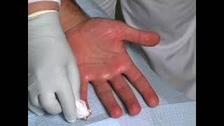 Botox for PALMAR Hyperhidrosis (#sweatypalms) Dr David Pariser, International Hyperhidrosis Society©