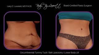 Circumferential Tummy Tuck Before and After | Belt Lipectomy | Lower Body Lift Results