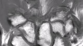 Avascular necrosis lunate bone (Kienbock's Disease)