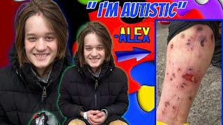 Severe Infections From Using. - Alex , 23 Yrs Old.