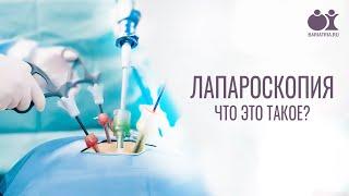 Что такое лапароскопическая операция?