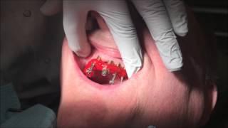 #allonx #allon4 Step-by-Step All-on-Four Dentures: Part 1: Impressions