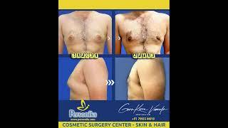 Gynecomastia Treatment @personiks ( Before & After comparison )