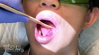 Grade 4 (severe) Tongue-Tie - Pre, Procedure, and Post Op Comments - The Breathe Institute