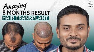 Hair Transplant in Tirupati | Best Results & Cost of Hair Transplant in Tirupati