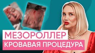 Вся правда про мезороллер! Реально ли он помогает и как проходит реабилитация?