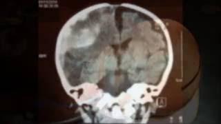 Chronic Subdural Hematoma with Acute Hemorrhage