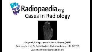 Finger clubbing MRI (Radiopaedia.org) Cases in Radiology