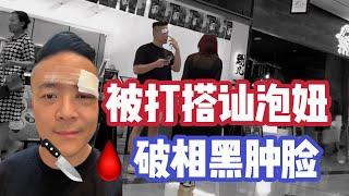 破相還能搭訕撩妹？女人以為被打 | 臉部受傷把妹 | 被打還上街？搭訕大師