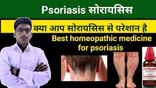 Psoriasis skin disease | Psoriasis homeopathic medicine | #psoriasis