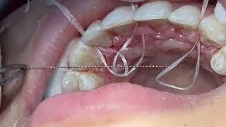 Fixed retainer steps, putting on post #bracestreatment  #retainer wire