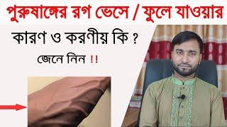 পুরুষাঙ্গের শিরা বা রগ ভেসে/ফুলে গেলে করণীয় কি ? ফুলে যাওয়ার কারণ কি !!