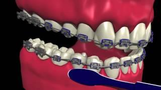 How to Brush and Floss with Braces - Marda Loop Braces - Dr. Andrew Chen