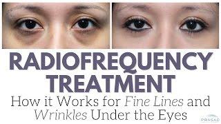 How Radiofrequency Devices Work on Fine Lines and Wrinkles, and Why it's Not the Only Treatment