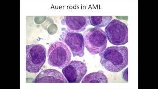 Acute Myeloid Leukemia (AML) [Highly Tested Topic]