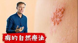 長癬的自然療法,柏格醫生Dr Berg