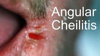 THE PAINFUL LIP - ANGULAR CHEILITIS