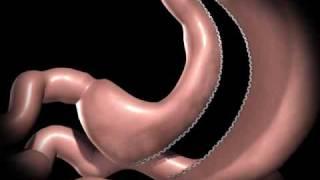 Sleeve Gastrectomy Surgery for Morbid Obesity