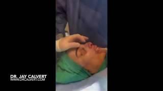 Dr Jay Calvert Rhinoplasty