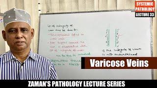 Systemic Pathology: Lecture 33 | Diseases of CVS : Day 03 - Varicose Veins