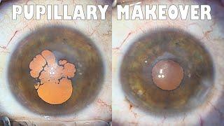 Pupillary makeover, tilt and chop, cough attack