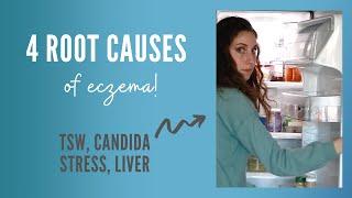 4 Root Causes of Eczema: Stress, Candida, Overworked liver, and TSW