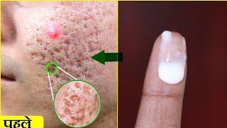 पिम्पल से हुए गड्ढे कैसे दूर करें | chicken pox ke gadde mitane ke upay