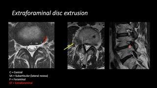 Lumbar Spine MRI by Eric Tranvinh, MD, Stanford Radiology