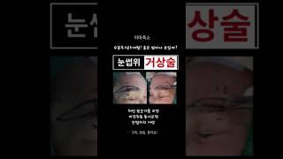 눈썹위거상술! 흉은 얼마나   보일까? #신촌성형외과 #연세자연미#미간주름동시교정 #눈썹거상#이마축소