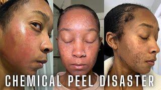 Chemical Peel Nightmare! Full Peeling Process. Before, During, and After. NEVER AGAIN