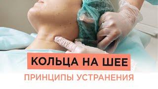 Как убрать КОЛЬЦА НА ШЕЕ? Разбираем варианты процедур