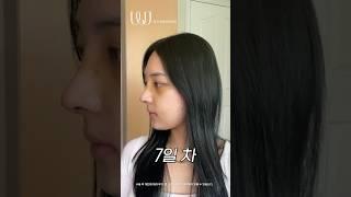 (리얼) 코 수술 부기 변화 과정 #shorts