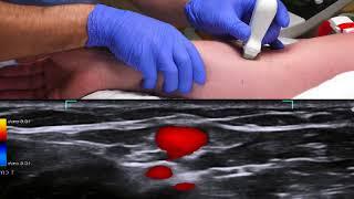 Ultrasound-guided peripheral venous cannulation