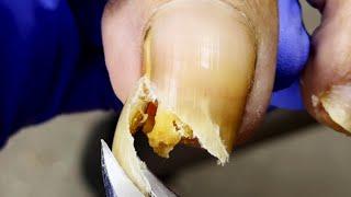Very Long Onychomycosis Nails, Trim Them Step By Step!【Dr. Liu's Pedicur】