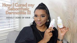 How I Cured my Seborrheic Dermatitis !!!! || A Daily Dose of Kris