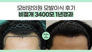   대구모발이식 M자모발이식 3400모 1년경과 l #대구탈모치료 #경북모발이식 l 압구정모비앙의원대구