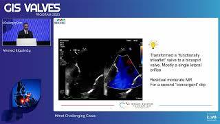 14  Mitral Challenging Cases   Ahmed Elguindy