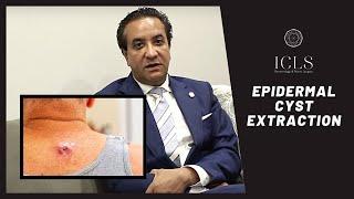 Epidermal Cysts Extraction | Dermatologist's Advice | ICLS Dermatology & Plastic Surgery