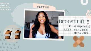 Breast lift w/o implants: Chit chat & SEE MY SCARS