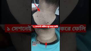 আঁচিল দূর হবে একবারেই। কিভাবে আঁচিল দূর করবেন? How to remove mole? Shorts