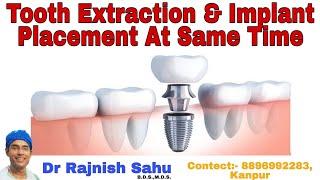 Dental Implant Placement|| Immediate Implant||@rajnishsahu82