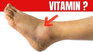 No.1 vitamin for removing leg and foot SWELLING!