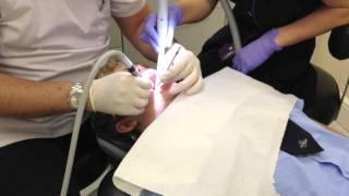 dentist injection drill and filling