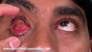 Artificial eye movements| Lost eye treatment| Prosthetic Eye