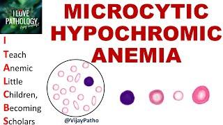 MICROCYTIC HYPOCHROMIC  ANEMIA.   Causes, Mechanism & Approach