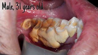 Half Jaw Quarter Hour Scaling | Dentist | Dokter Gigi Tri Putra