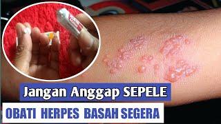 Cara obati herpes basah penyakit kulit melepuh