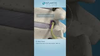 Lumbar Lateral Stenosis #Shorts ​@Atlantic Spine Center