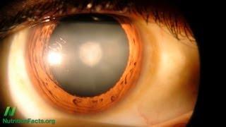 Preventing Cataracts with Diet